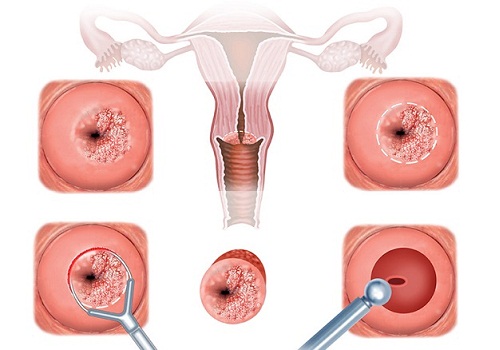 Bị viêm lộ tuyến tử cung có mang thai được không? nguy hiểm không?