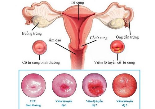 Lộ tuyến cổ tử cung là gì? phân loại viêm lộ tuyến