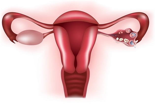 Vô sinh nữ do mắc các  bệnh về buồng trứng