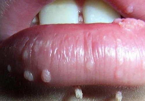 Sùi mào gà ở miệng: Nguyên nhân, triệu chứng và cách điều trị