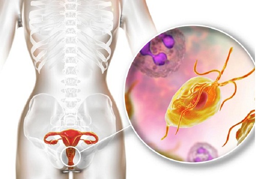 Tác hại bệnh viêm âm đạo do trùng roi đến sức khỏe và sinh lý nữ