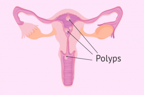 Dấu hiệu nhận biết Polyp tử cung và cách chuẩn đoán chính xác