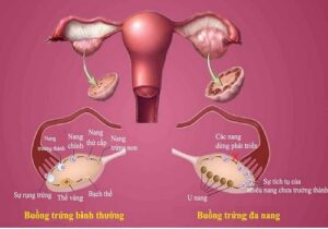 Phương pháp điều trị đa nang buồng trứng và những lưu ý cần thiết