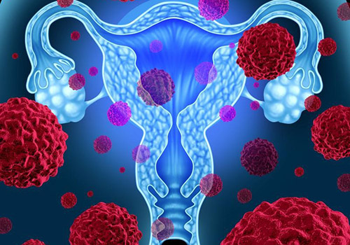 Polyp tử cung có gây vô sinh không, ảnh hưởng như thế nào?