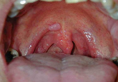 Sùi mào gà ở miệng: Nguyên nhân, triệu chứng và cách điều trị