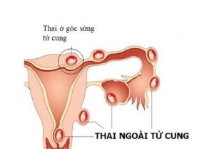Thai ngoài tử cung và các biến chứng nguy hiểm, cần đề phòng 