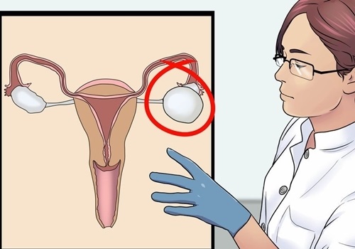 U nang buồng trứng là khối u chứa chất dịch lỏng bất thường phát triển bên trong