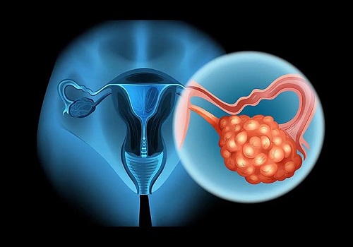 U nang buồng trứng: Nguyên nhân, triệu chứng và cách chữa trị