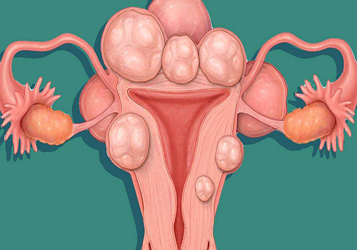 U xơ tử cung là như thế nào, dấu hiệu nhận biết bệnh?