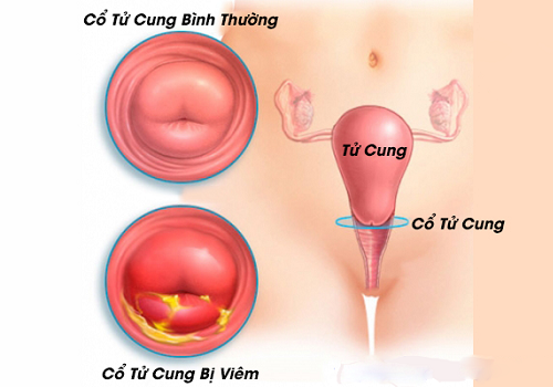 Viêm cổ tử cung: Nguyên nhân, dấu hiệu và cách điều trị hiệu quả