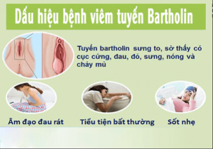 Dấu hiệu bệnh viêm tuyến bartholin