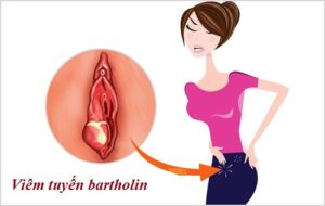 Những thông tin cần biết về viêm tuyến bartholin