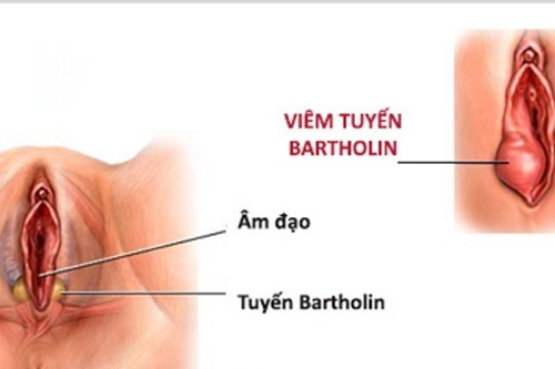 Viêm tuyến bartholin 
