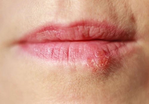 Bị herpes sinh dục bôi thuốc gì mau khỏi nhất?