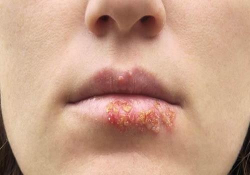 Mụn rộp sinh dục (herpes) ở môi, cách xử lý tại nhà