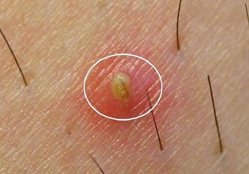 Nổi mụn thịt ở vùng kín là bệnh gì? Bác sĩ chuyên khoa giải đáp