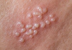 Mụn rộp sinh dục nam giới - Hình ảnh triệu chứng và cách điều trị hiệu quả