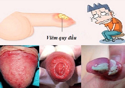 Nguyên nhân dương vật chảy mủ và các dấu hiệu đặc trưng