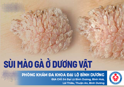 sùi mào gà dương vật