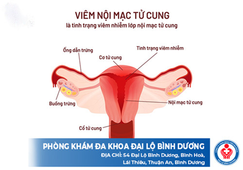 viêm nội mạc tử cung