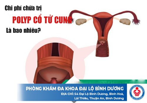 chi phí cắt polyp cổ tử cung ở Bình Dương