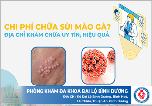 chi phí điều trị sùi mào gà tại Bình Dương