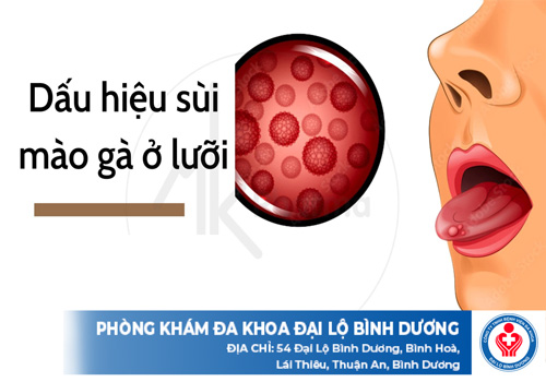 dấu hiệu bệnh sùi mào gà ở lưỡi