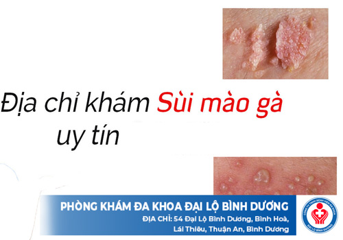 địa chỉ chữa sùi mào gà ở Bến Cát