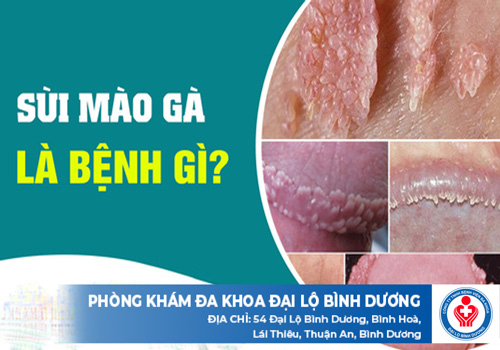 địa chỉ chữa sùi mào gà ở Dầu Tiếng