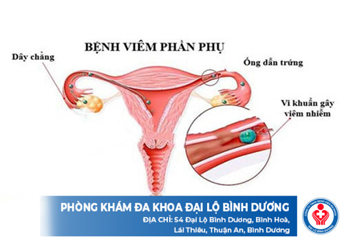 điều trị viêm phần phụ ở Bình Dương