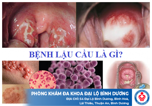 top dia chi chua benh lau phu giao 1