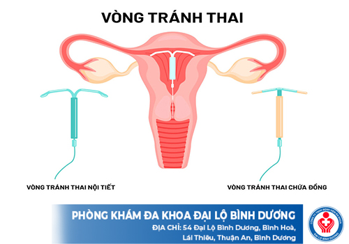 Top Địa Chỉ Đặt Vòng Tránh Thai Ở Bến Cát 2 top dia chi dat vong tranh thai o dong nai 1