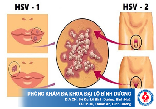 kham benh mun rop sinh duc o tan uyen 19915 1