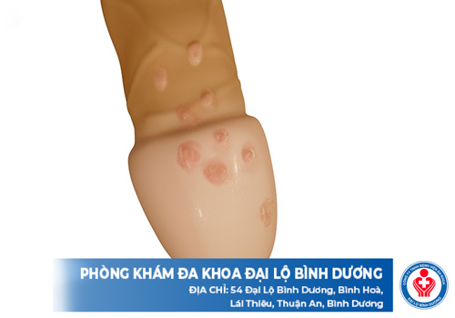bao quy dau dai moc mun nuoc 1