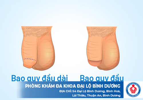 benh dai bao quy dau 1