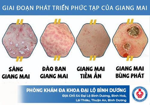nam ro giai doan giang mai de kham giang mai o quan 5 kip thoi nam ro giai doan giang mai de kham giang mai o quan 5 kip thoi