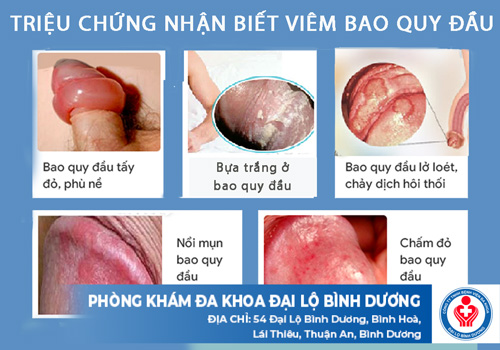 trieu chung viem bao quy dau
