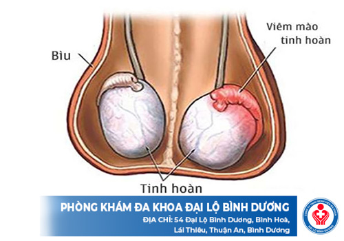 viem tinh hoan va viem mao tinh hoan 1