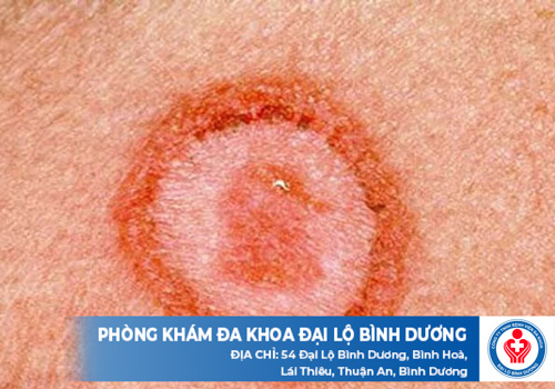 hieu ve benh de kham giang mai o quan 9 kip thoi