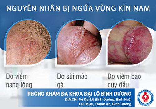 nguyen nhan bi ngua vung kin nam